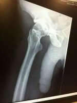 hIP xRAY.jpg